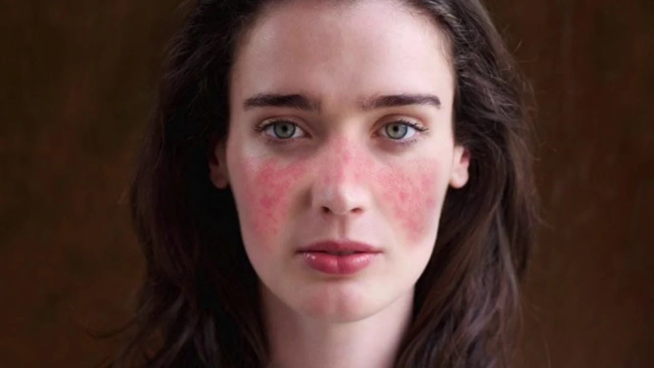 Lupus Hastalığı Belirtileri Nedir?