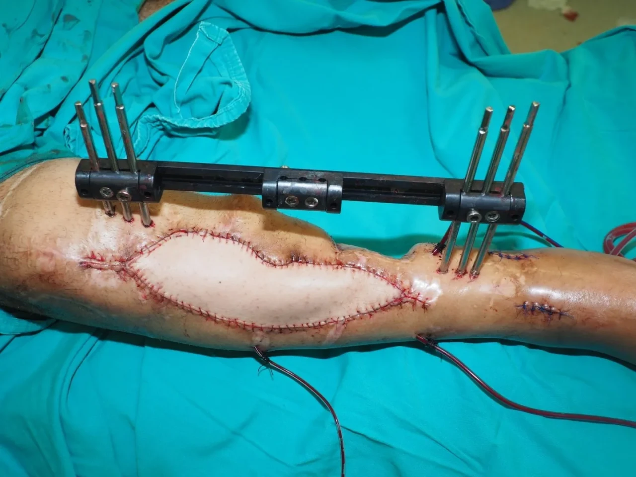 Kütahya'da mikrocerrahi operasyonla uzun süredir iyileşmeyen bacak kırığı tedavi edildi