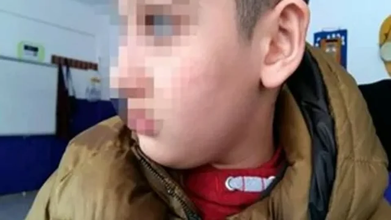 Bursa'da otizmli öğrencinin vücudunda 54 morluk bulundu, öğretmeni açığa alındı
