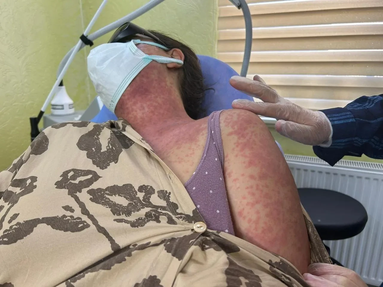 Van'da beyazlatıcı krem kullanan 4 kişi ağır yanıklarla hastanelik oldu