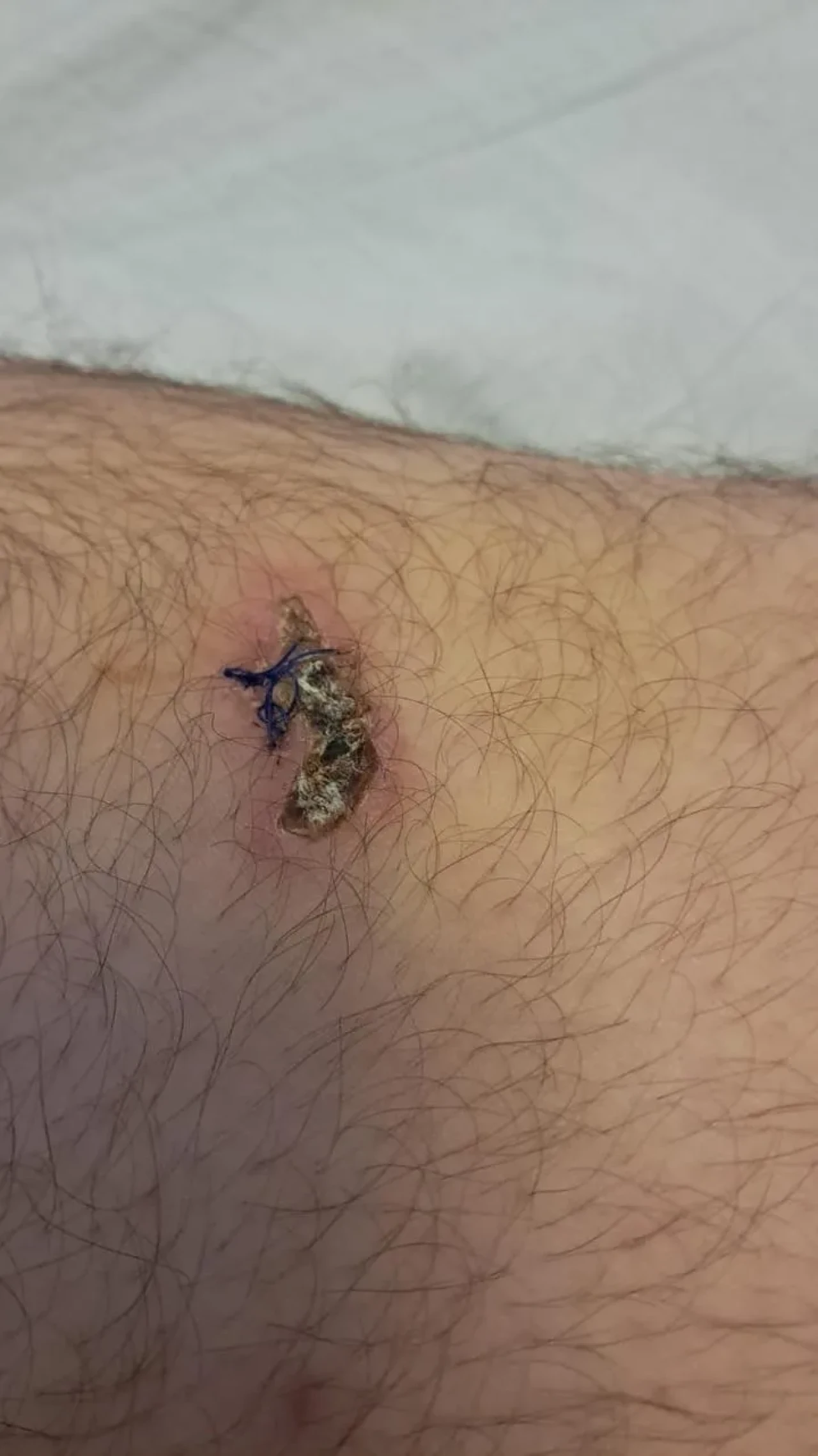 Bolu Mudurnu’da Ertan Kan ayı saldırısında yaralandı ve parmağını kaybetti