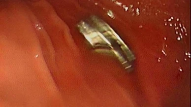 Elazığ'da çocuğun yuttuğu 19 mıknatıs Fırat Üniversitesi Hastanesinde çıkarıldı