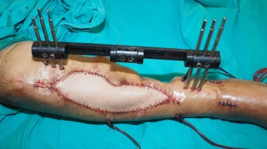 Kütahya'da mikrocerrahi operasyonla uzun süredir iyileşmeyen bacak kırığı tedavi edildi