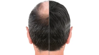 Dünyanın Saç Ekimi Başkenti: İstanbul