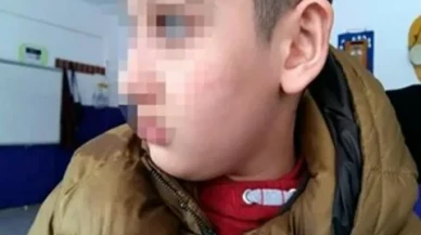 Bursa'da otizmli öğrencinin vücudunda 54 morluk bulundu, öğretmeni açığa alındı