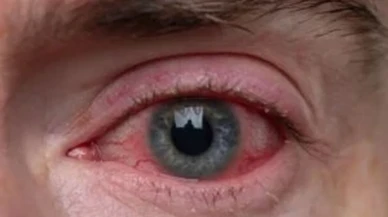 Bahar geldi! Polenlerden korunmak için alınması gereken önlemler ve göz nezlesi hakkında bilinmesi gerekenler