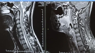 MS tedavisinde erken teşhisin önemi ortaya çıktı