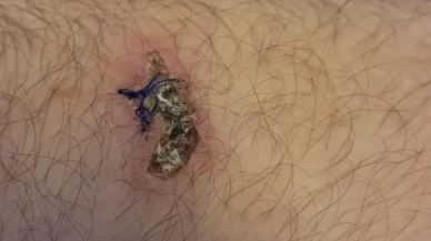 Bolu Mudurnu’da Ertan Kan ayı saldırısında yaralandı ve parmağını kaybetti