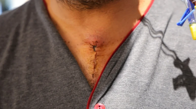 Kahramanmaraş'ta 20 dakika beyin dolaşımı durdurulan hasta başarılı ameliyatla sağlığına kavuştu